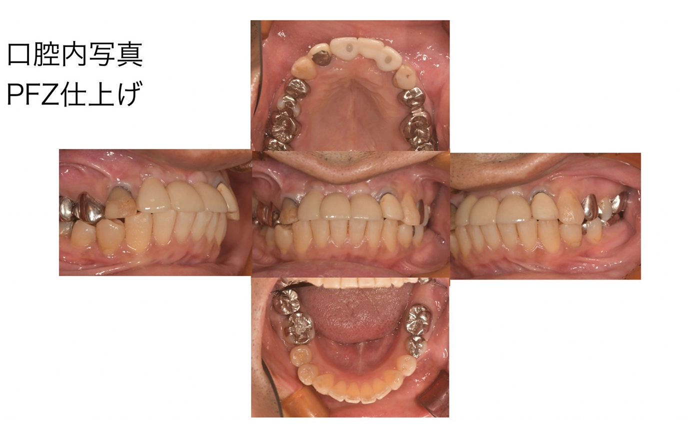 前歯のインプラント