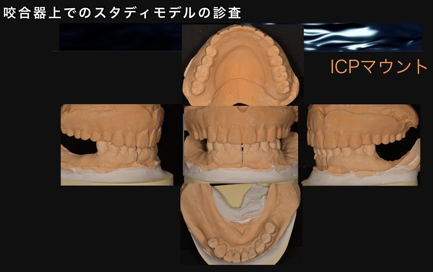 奥歯のインプラント