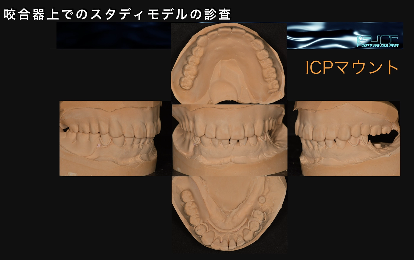 奥歯のインプラント