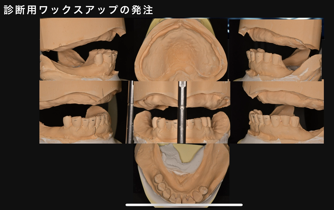 奥歯のインプラント