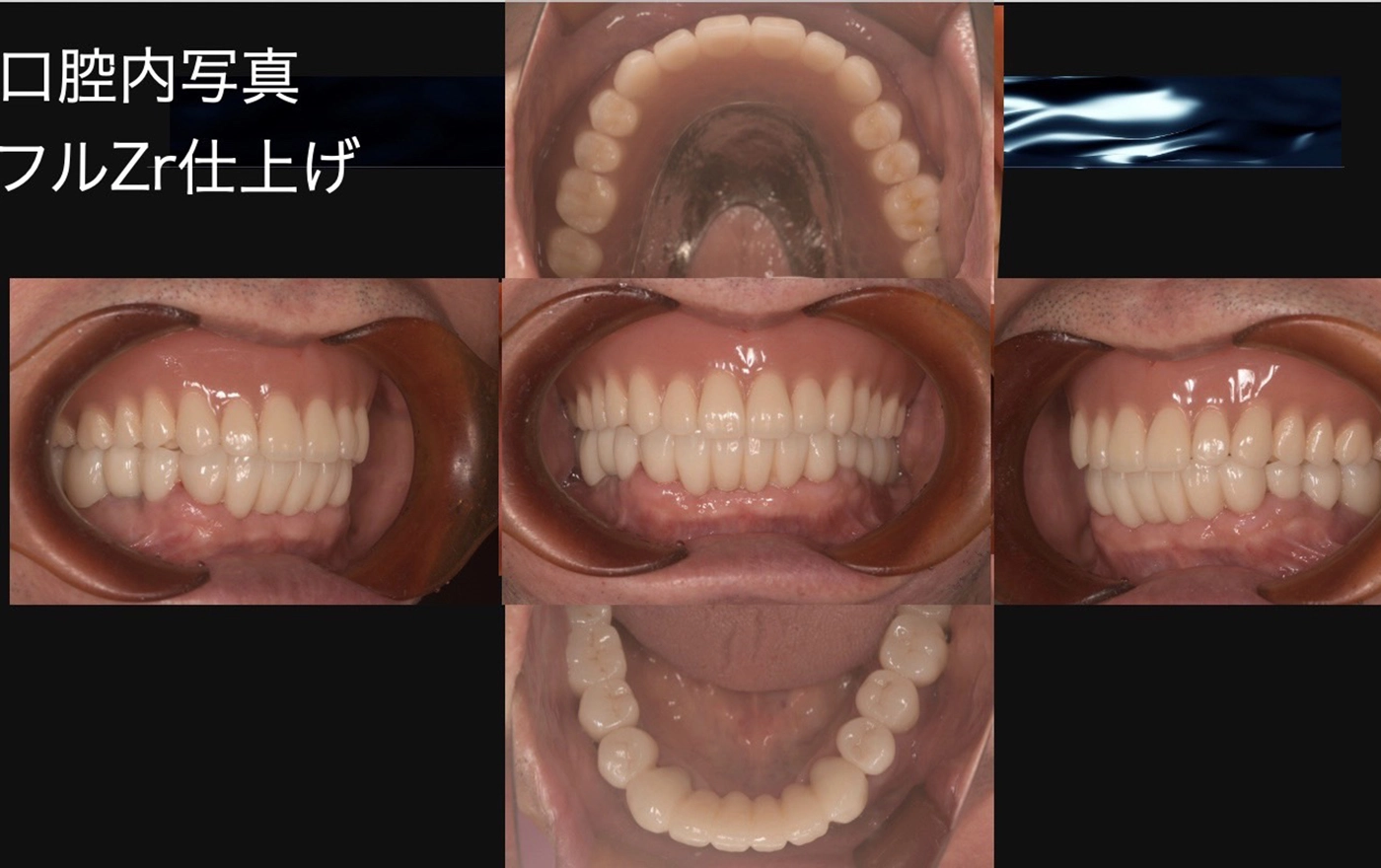 奥歯のインプラント