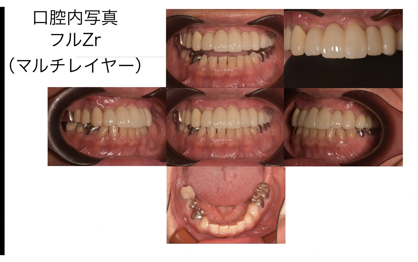 歯がボロボロ